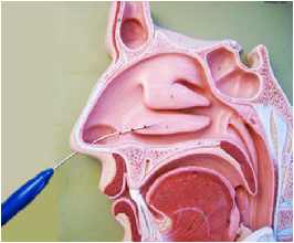 Inferior Turbinate Hypertrophy